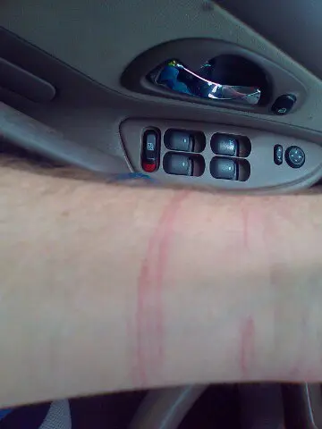 Cut Wrists Springville2